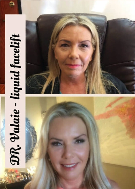 Liquid Facelift