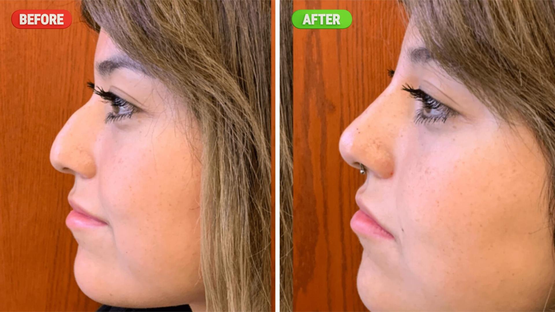 Liquid Nose Job