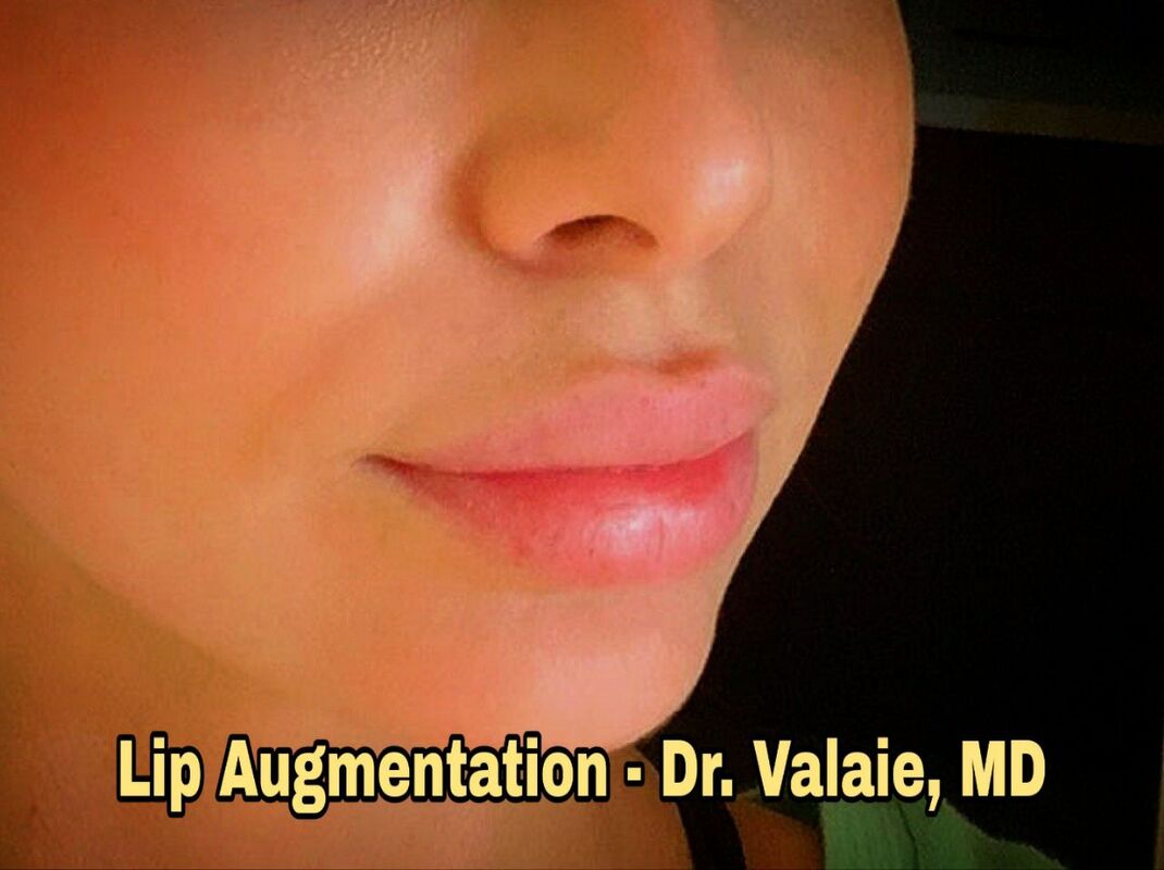 Lip Augmentation