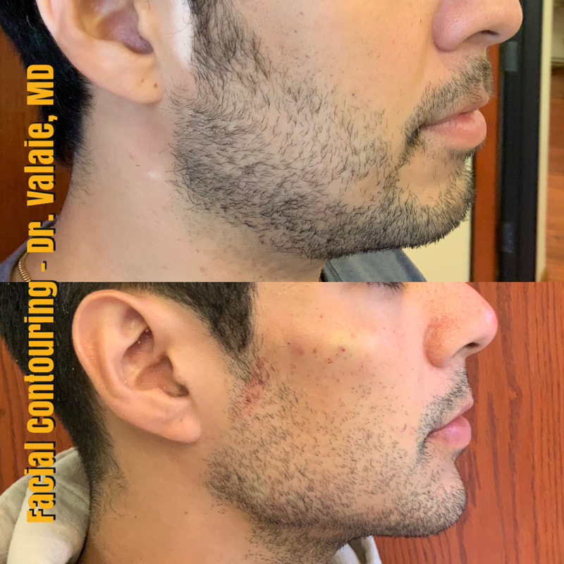 Facial Contouring