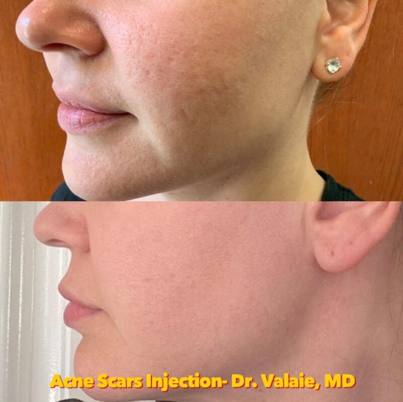 Acne Scars Injection
